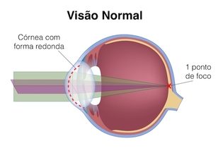 Visão normal - Sem miopia, astigmatismo ou hipermetropia